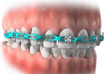 تصویر 1 از قیمت خرید اورینگ ارتودنسی مشکی + فروش ویژه