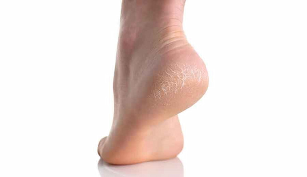 قیمت خرید کرم ترک پا گیاهی با فروش عمده