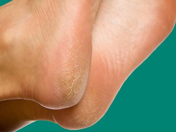تصویر 1 از خرید کرم ترک پا + قیمت فروش استثنایی