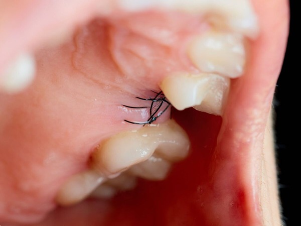 تصویر 3 از فروش نخ بخیه جذبی دندانپزشکی + قیمت خرید به صرفه