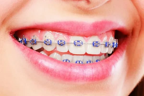 تصویر 3 از خرید ارتودنسی فک بالا + قیمت فروش استثنایی