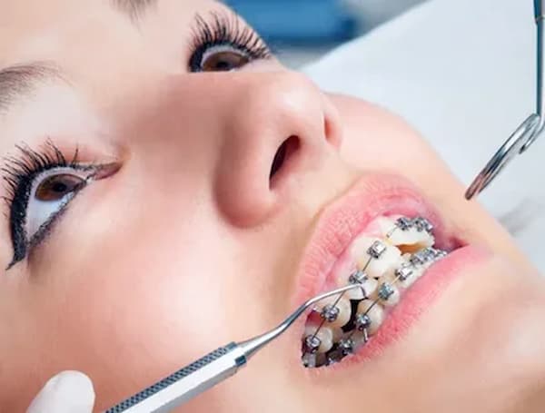 تصویر 5 از خرید ارتودنسی فک بالا + قیمت فروش استثنایی
