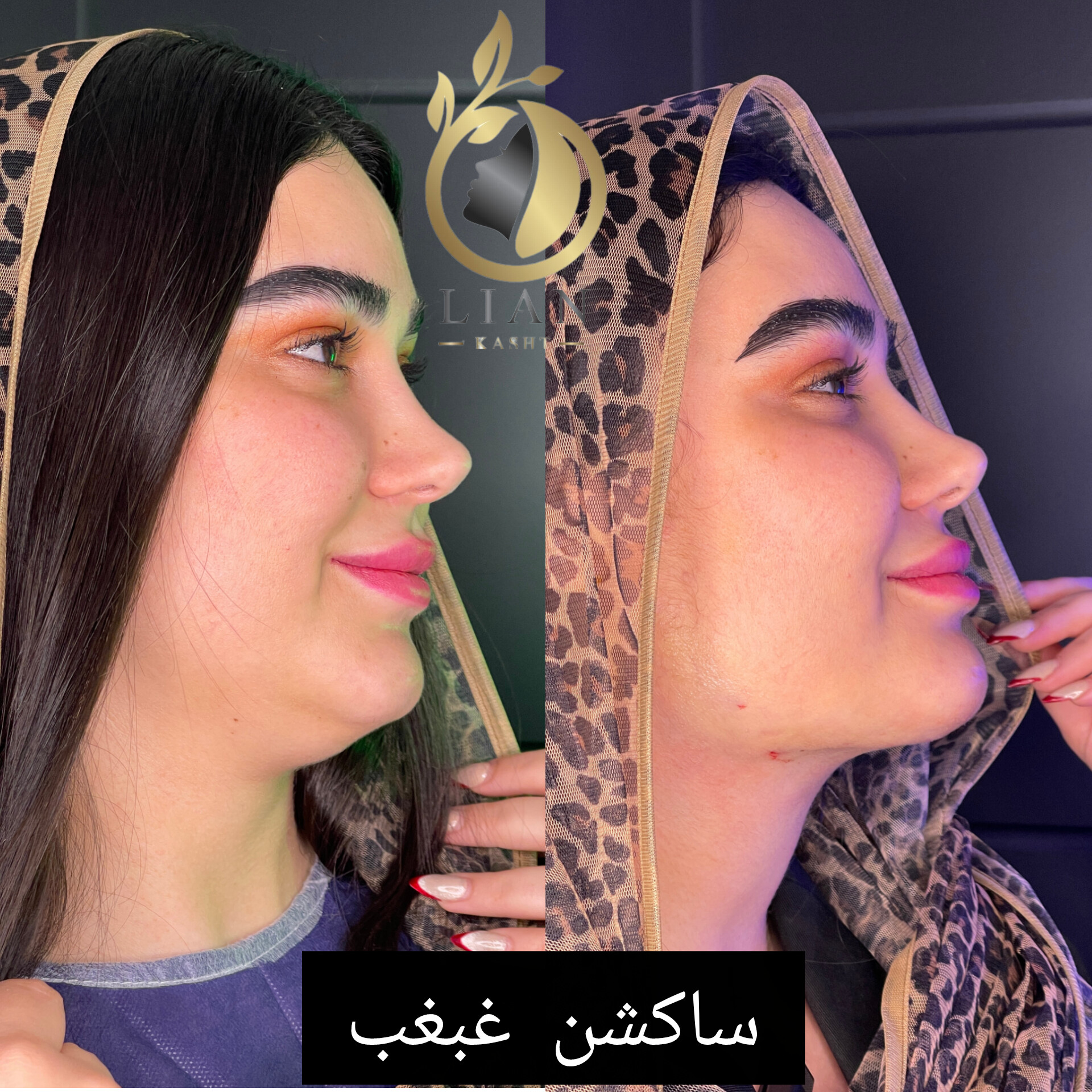 ساکشن غبغب با کیفیت و قیمت مناسب