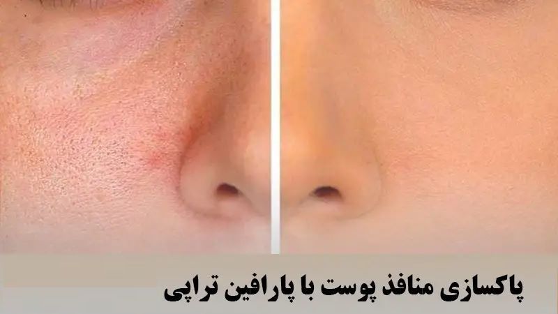 تصویر 1 از فروش پارافین طبیعی پوست صورت و بدن قیمت عالی با کیفیت