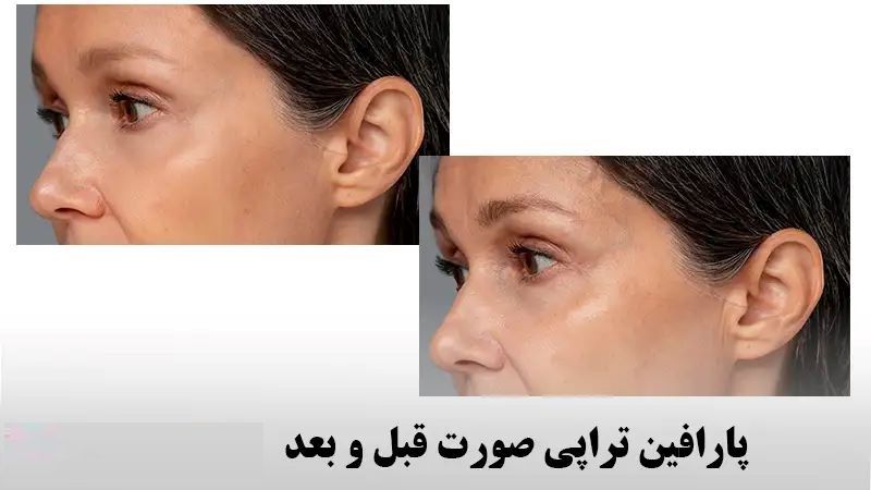 تصویر 3 از فروش پارافین طبیعی پوست صورت و بدن قیمت عالی با کیفیت