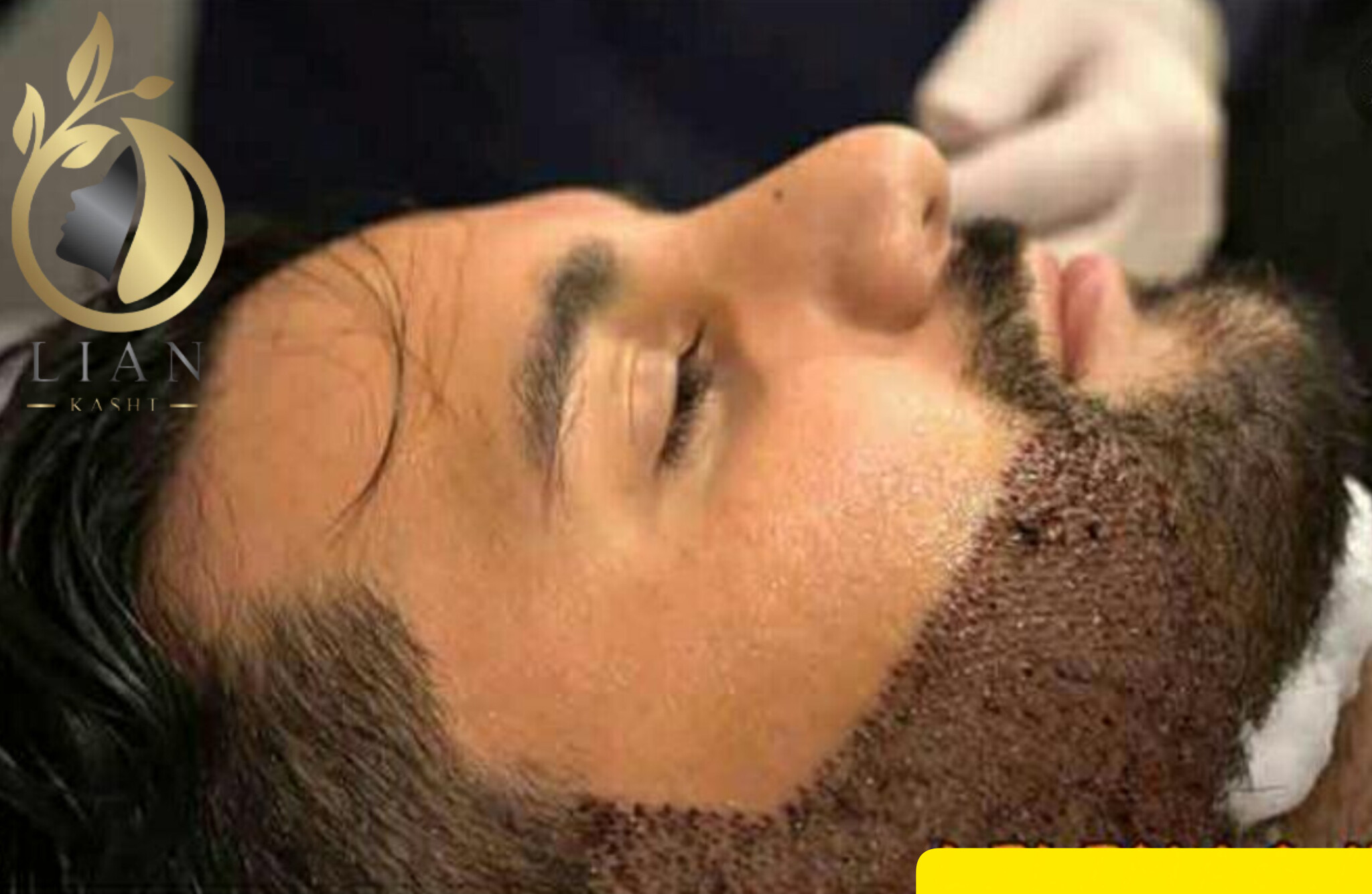 کاشت ریش طبیعی