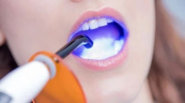 تصویر 5 از قیمت خرید دستگاه لایت کیور دندانپزشکی با فروش عمده