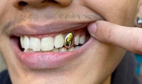 تصویر 3 از قیمت روکش دندان طلا + خرید باور نکردنی