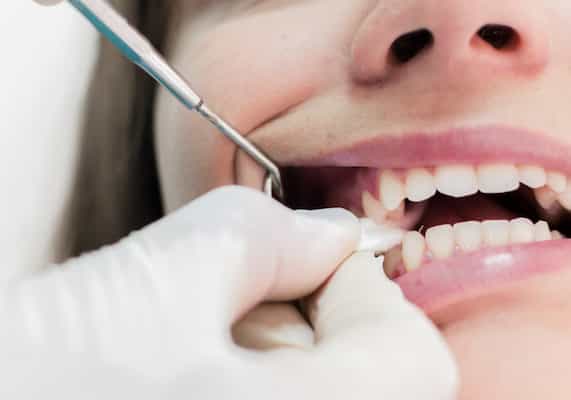 تصویر 5 از قیمت خرید گاز دندانپزشکی یکبار مصرف نفیس + فروش ویژه