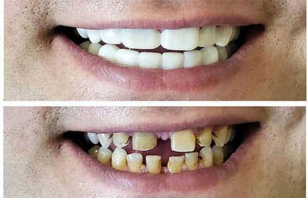 تصویر 3 از فروش لمینت متحرک دندان + قیمت خرید به صرفه