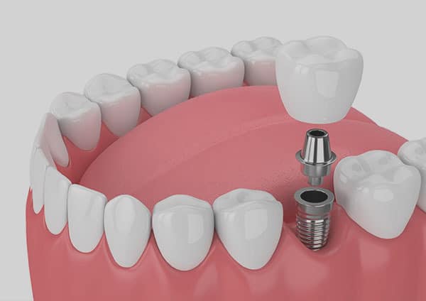 تصویر 5 از فروش دندان متحرک تکی + قیمت خرید به صرفه
